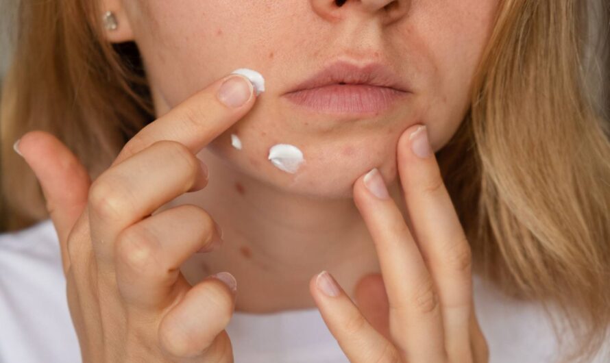 Dietetyka a trądzik zaskórnikowy