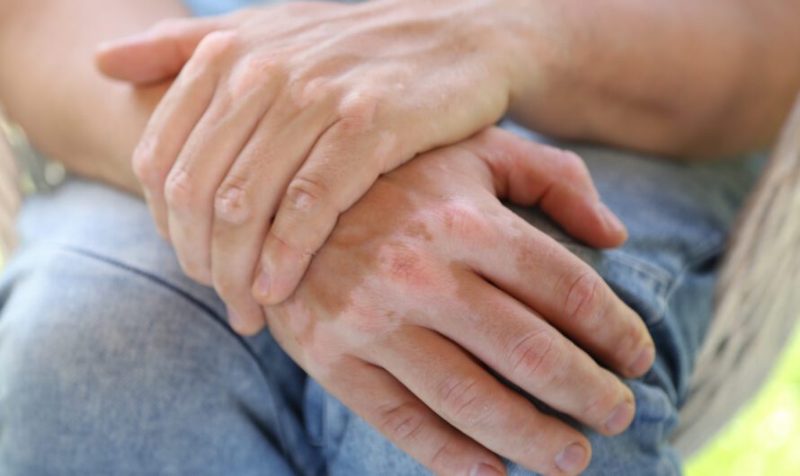 Bielactwo – co to jest i gdzie pojawia się najpierw?